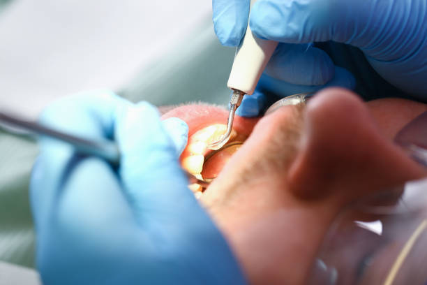 Best Emergency Tooth Extraction in Wichita Falls, TX