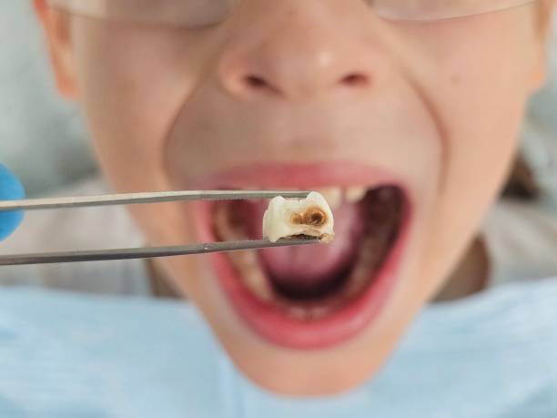 Best Emergency Root Canal Treatment in Wichita Falls, TX